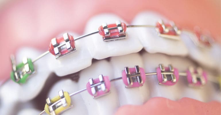 braces on teeth