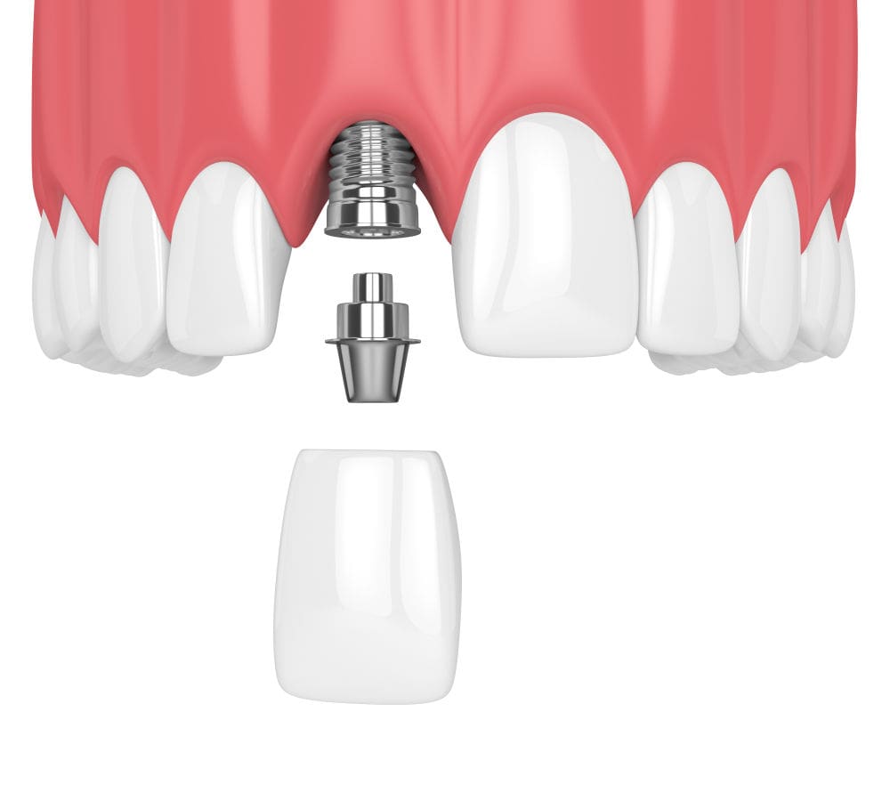 dental crown