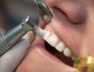 dental cleaning