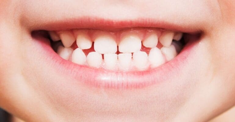 dental sealants