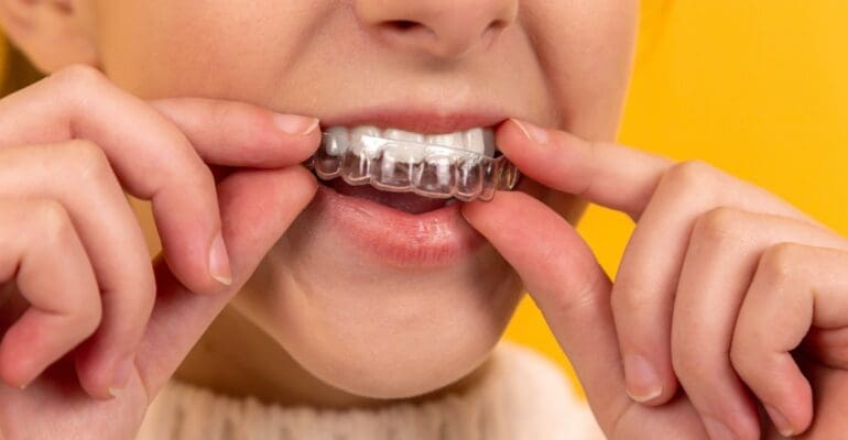 invisalign